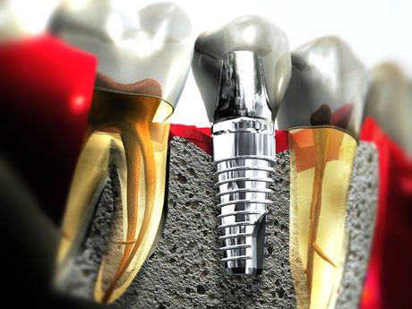 IMPLANT from A TO Z COURSE